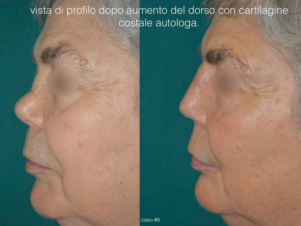 rinoplastica ricostruttiva profilo