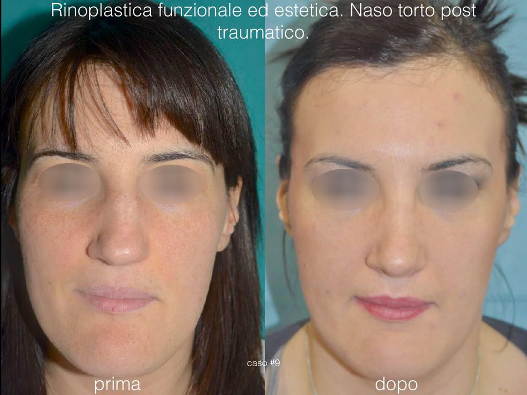 rinoplastica funzionale-estetica-frontale