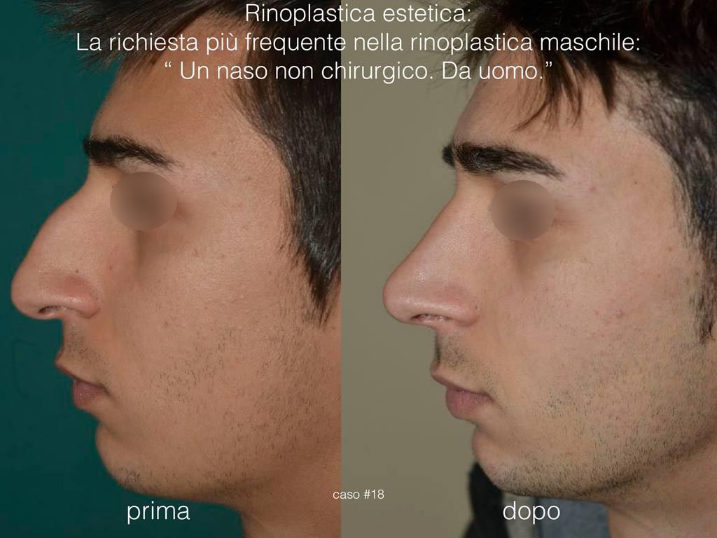 rinoplastica-estetica-profilo