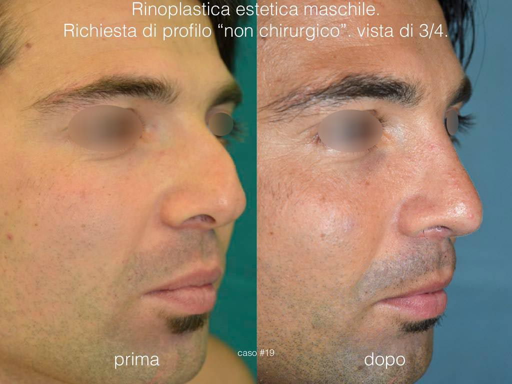 rinoplastica-estetica-profilo