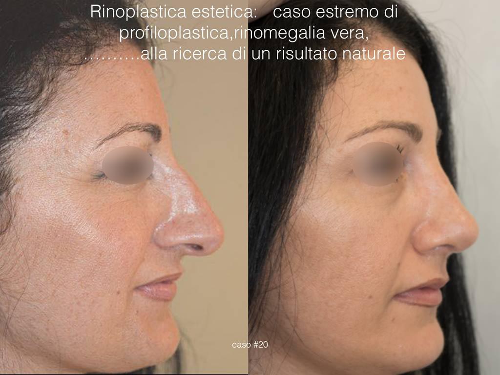 rinoplastica-estetica-profilo-dx