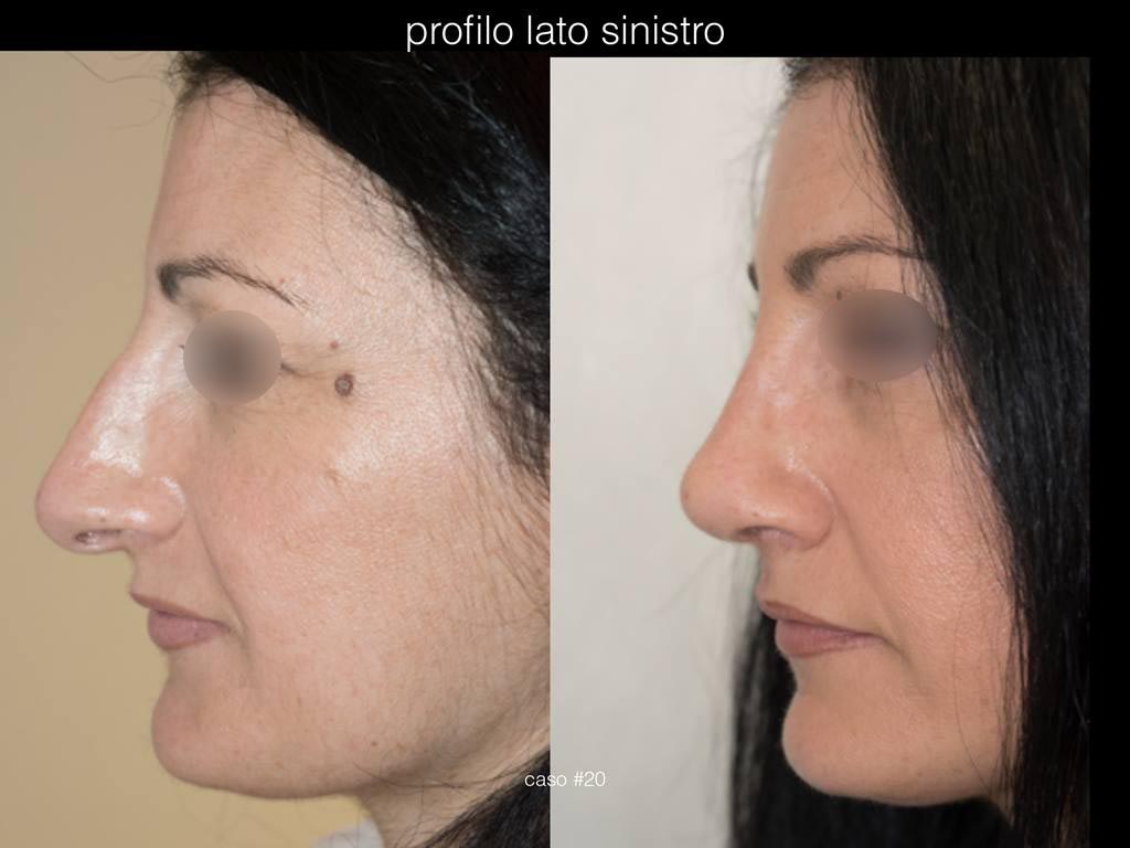 rinoplastica-estetica-profilo-sx