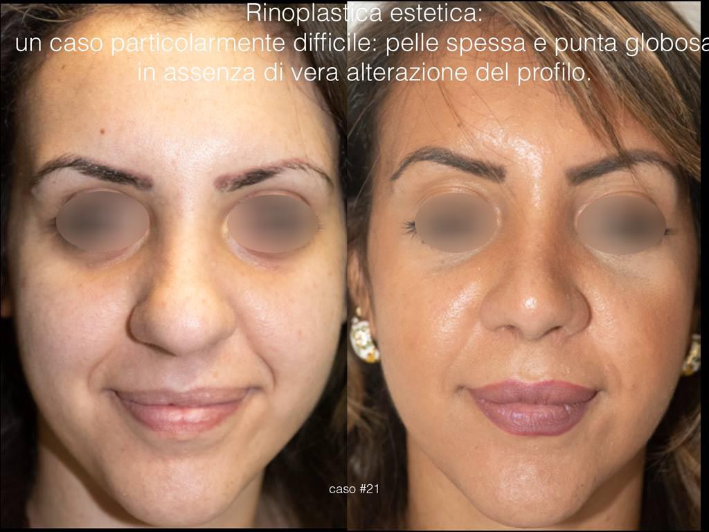 rinoplastica-estetica-frontale