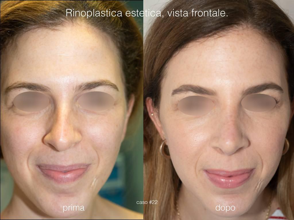 rinoplastica-estetica-frontale