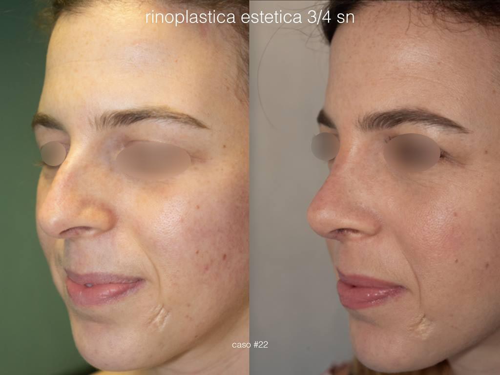 rinoplastica-estetica