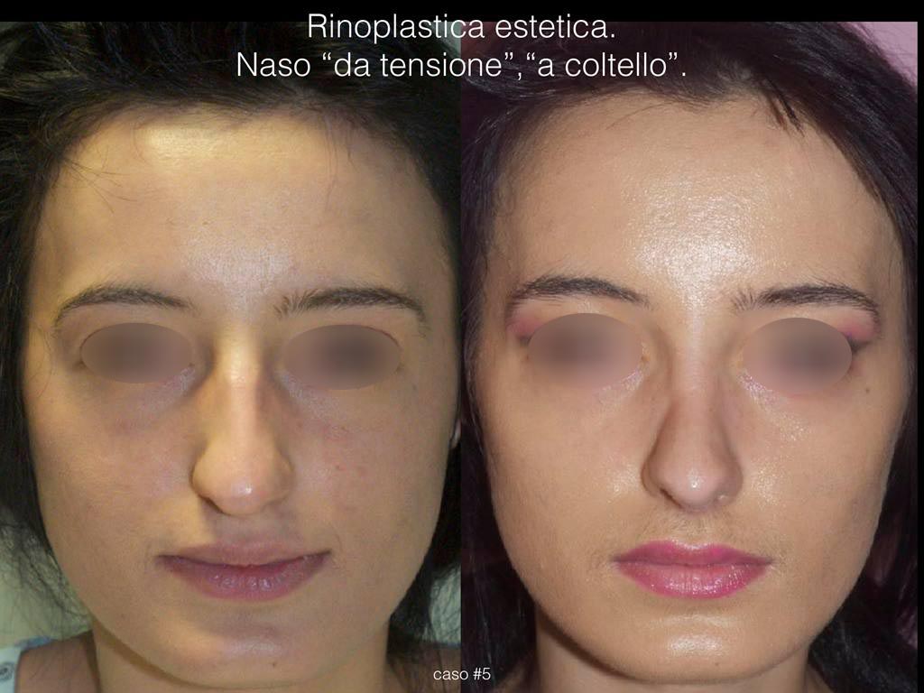 rinoplastica-estetica-frontale