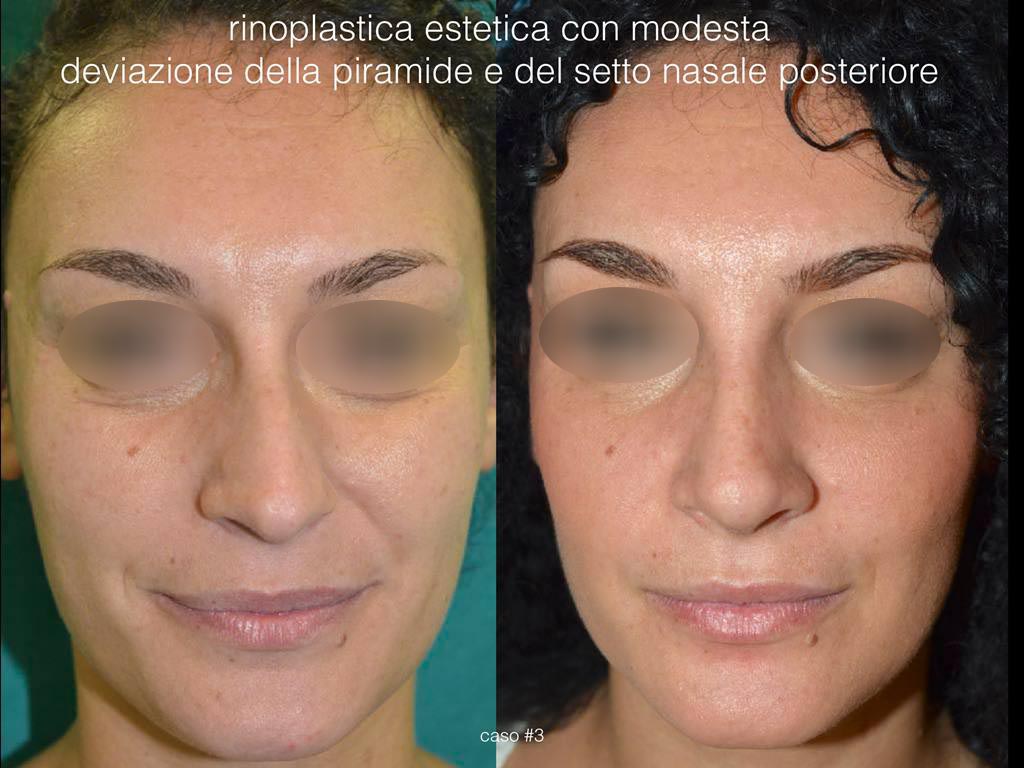 rinoplastica estetica frontale